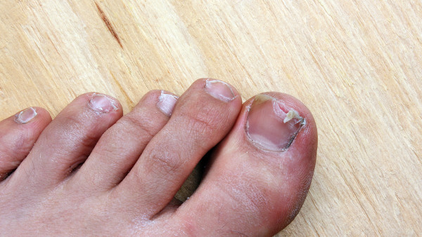 指甲上有白色斑点是怎么回事 导致指甲上有白色斑点的病因都有哪些