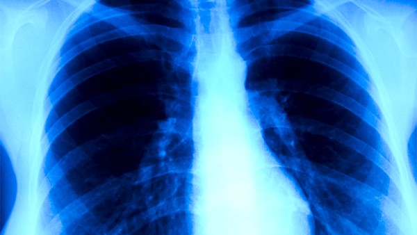 老慢支肺气肿中成药有哪些 肺气肿ct表现是什么样的
