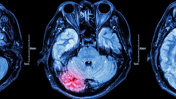 脑梗塞病情加重是怎么回事