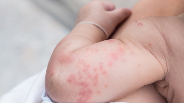小儿湿疹最好根治方法  宝宝湿疹用什么药最好