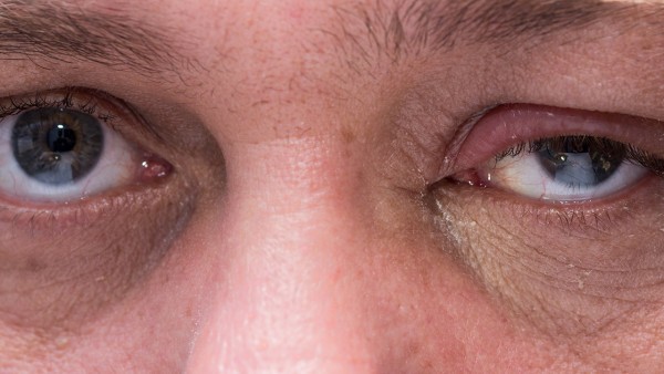 治疗眼结石眼药水有哪些  什么眼药水缓解眼结石