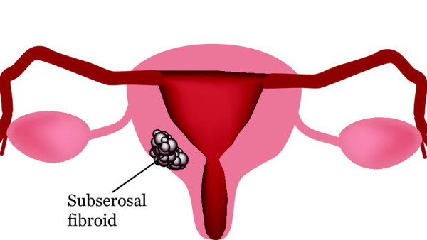 子宫肌瘤息肉怕什么食物 有子宫肌瘤子宫息肉什么不能吃