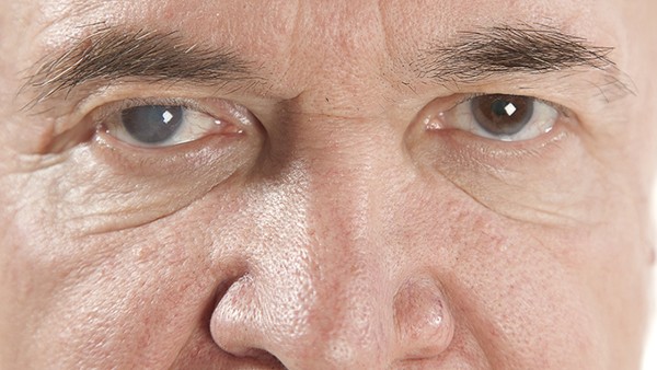 眼睛的飞蚊症怎么治疗和预防