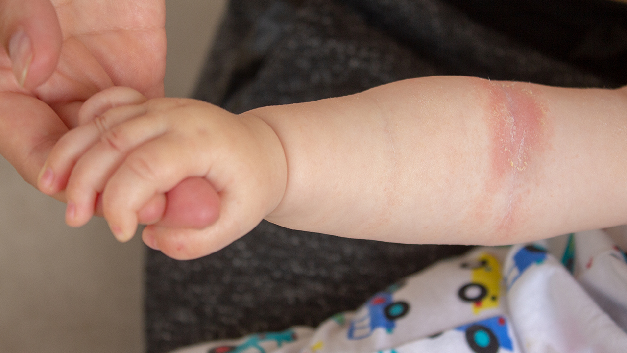 婴儿湿疹是什么原因造成的